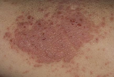 Tratamentul și cauzele eczeme microbiene