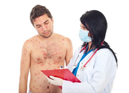 Tratamentul și cauzele eczeme microbiene