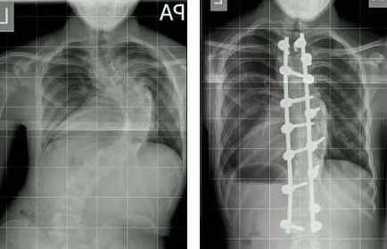 curbură a coloanei vertebrale Tratamentul de ce să facă și cum să corecteze exerciții