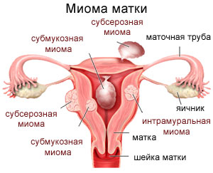 fibrom uterin tratamentul metodelor tradiționale