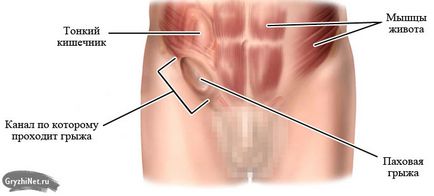 Tratamentul inghinala hernie fără operație metoda 4 de lucru