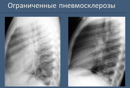 Tratamentul fibrozei pulmonare