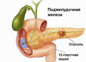 Tratamentul de remedii populare de cancer pancreatic