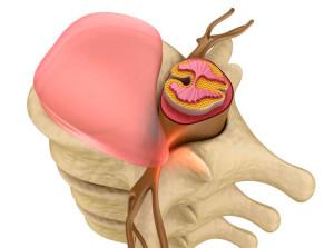 Tratamentul protruzia discului a coloanei vertebrale lombare