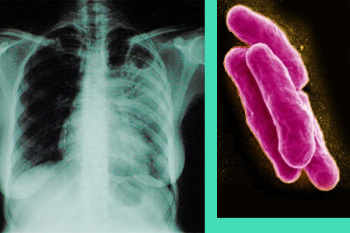 remedii populare TB de tratament
