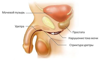 Tratamentul uretrita la bărbați remedii populare - ierburi și alte metode