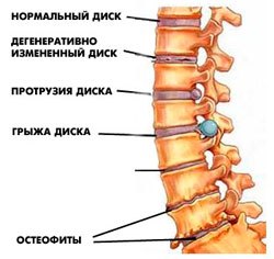 Tratamentul de remedii populare chondrosis