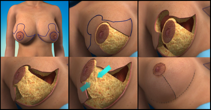 Mamoplastia de reducere - ceea ce este și în ce cazuri este necesar