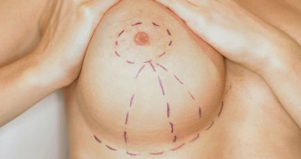 Mamoplastia de reducere - ceea ce este și în ce cazuri este necesar