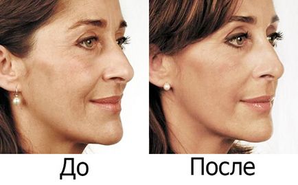 mască de față cu „Dimexidum“ impotriva ridurilor si acnee