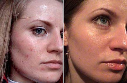 Masca faciala cu retete Dimexidum de riduri, acnee, comentarii