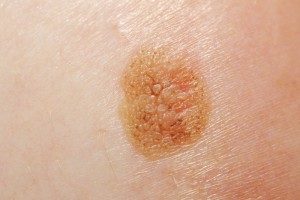 melanomul tegumentar foto și stadiul inițial, prognosticul