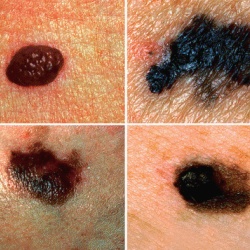 Melanomul de simptome ale pielii, tratamentul și prevenirea remedii populare