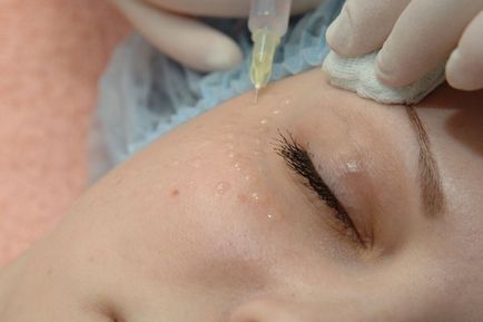 Mezoterapia pret fata, comentarii, fotografii înainte și după video (foto) Mezoterapia pret fata, comentarii, fotografii înainte și după video