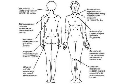 Mialgii - simptome, tratament, prevenirea bolilor