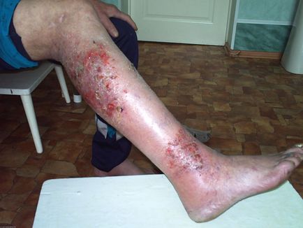 eczeme microbiana pe mâini și picioare de tratament, cauze, unguent