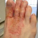 Microbiana eczeme - cauze, simptome, diagnostic și tratament