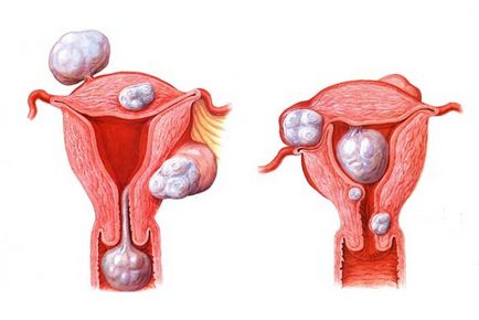 fibroame cauze si tratament de col uterin