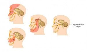 simptome nervoase facial nevralgii si tratament