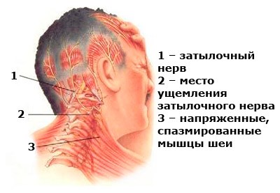 Nevralgia occipitală cauze nervoase, simptome, tratament