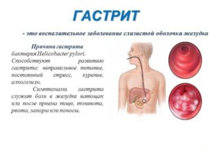 Senzație de un nod în stomac - cauzele, tratamentul, prevenirea