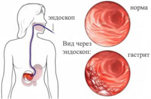 Senzație de un nod în stomac - cauzele, tratamentul, prevenirea