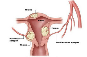 Principalele cauze ale simptomelor fibrom uterin si patologia