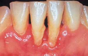 Periodontita, dinte - ceea ce este semnat cu fotografii, tratament la domiciliu