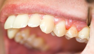 Periodontita, dinte - ceea ce este semnat cu fotografii, tratament la domiciliu