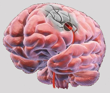 Primele semne si simptome de accident vascular cerebral si atac de cord la femei tratament de prim ajutor