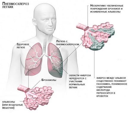 Fibroza pulmonara ceea ce este și cum să trateze oamenilor mijloacele