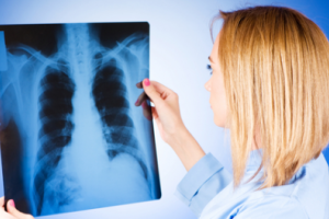 Fibroza pulmonara ceea ce este și cum să trateze oamenilor mijloacele