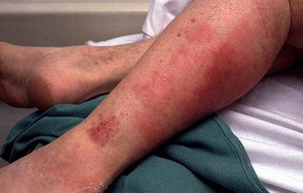 De ce sunt mâncărime picioarele sub genunchi cauze simptome