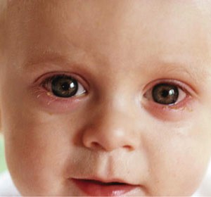De ce se poate inrosi albului ochilor cum să scape de boală