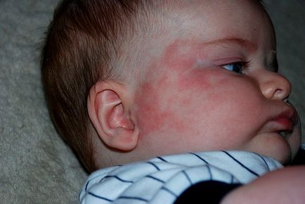 De ce este o alergie la sugari, simptome, metode de tratament si prevenire