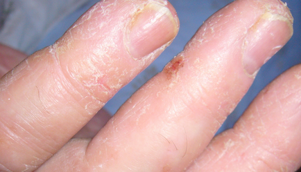 De ce este pielea uscată și crăpată de pe mâini, boli de piele