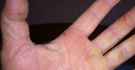 De ce este pielea uscată și crăpată de pe mâini, boli de piele
