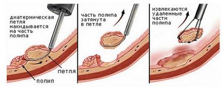 Polipectomia - ce fel de operațiune și care este prezentat (funcționare) Polipectomia - ce fel de operațiune și care arată