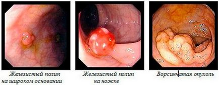 Polipectomia - ce fel de operațiune și care arată