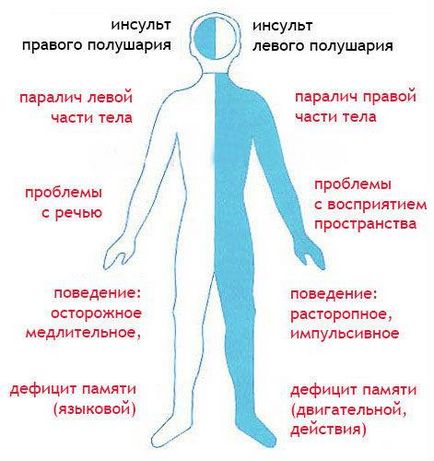 Consecințele dreapta accident vascular cerebral hemoragic și stângă ale creierului