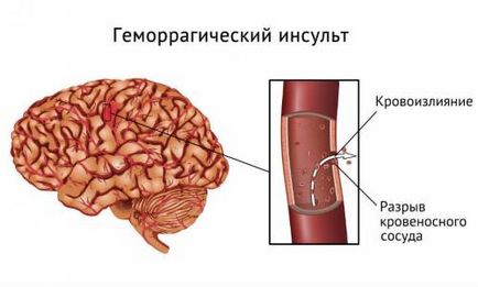 Consecințele dreapta accident vascular cerebral hemoragic și stângă ale creierului