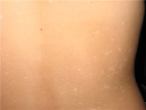 Apariția unor pete albe pe piele a ceea ce este, cum să trateze petele luminoase de pe spate și fotografii ale corpului