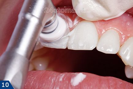 curățare profesională a dinților - cum ar trebui să fie, prețul