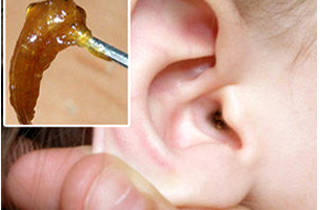 Spalarea urechea de cerumen - cum și ce acestea pot fi curățate