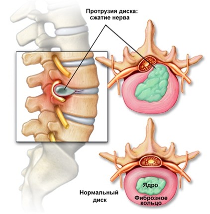 Proeminența cauze coloanei vertebrale lombare, simptome și tratament