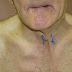 paralizie pseudobulbară și tulburare bulbară că este (situat bulb rahidian) paralizie pseudobulbară și tulburare bulbară că este