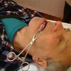 paralizie pseudobulbară și tulburare bulbară că este (tulburare) paralizie pseudobulbară și tulburare bulbară că este