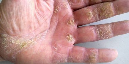 Psoriazisul pe mâinile sale - tratament într-un stadiu incipient, simptomele și cauzele bolii
