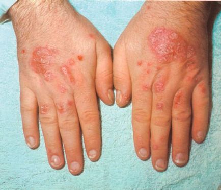 Tratamentul Psoriazis pe căile de atac mâini populare