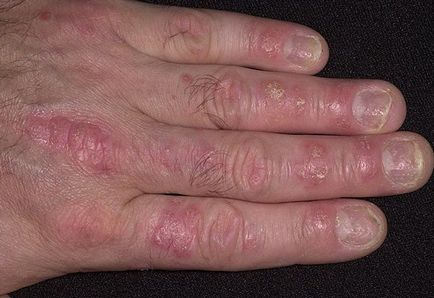 Psoriazisul pe mâinile în stadiu inițial - psoriazis pe tratamentul lui mâini